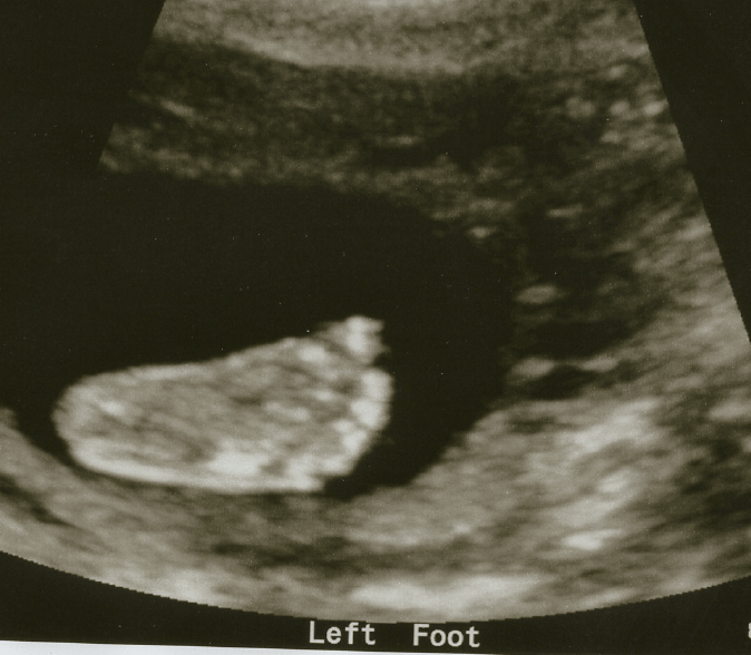 BB1 - 20 Weeks Left Foot