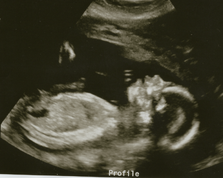 BB1 - 20 Weeks Profile.png